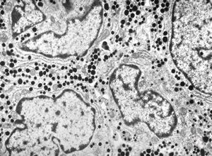 M, 16y. | acidophilic pituitary adenoma (STH M, 16y. | acidophilic pituitary adenoma (STH